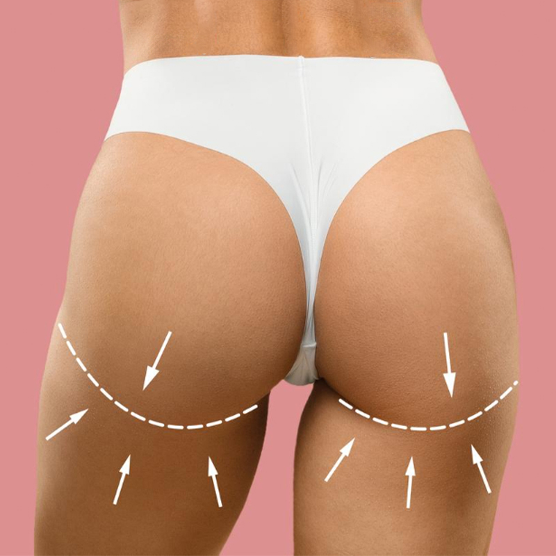 Buttock implant Turkey price